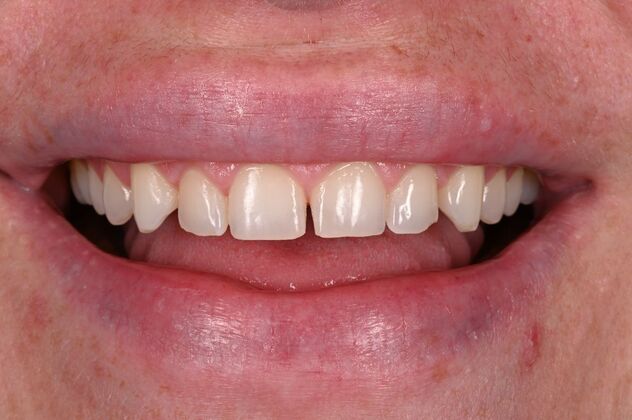 Before and Afters Case 3 - Ceramic Veneers - Before