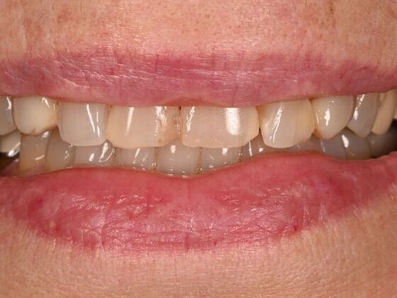 Before and Afters: Case 4 - Composite Veneers - Before