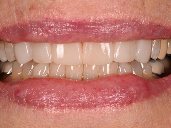 Before and Afters: Case 4 - Composite Veneers - After