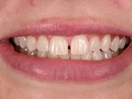 Before and Afters: Case 5 - Composite Veneers - Before