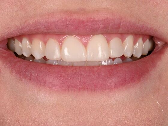Before and Afters: Case 5 - Composite Veneers - After