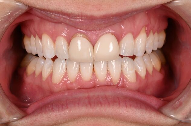 Before and Afters Case 6 - Crowns Replacement  - Before