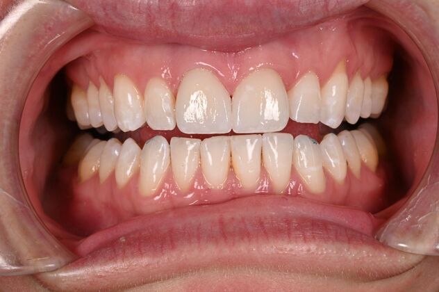 Before and Afters Case 6 - Crowns Replacement  - After
