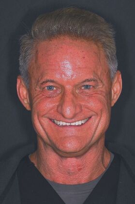 Before and Afters Case 2 - Smile Makeover - Before