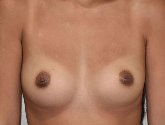 Breast Augmentation Case 26 - Before