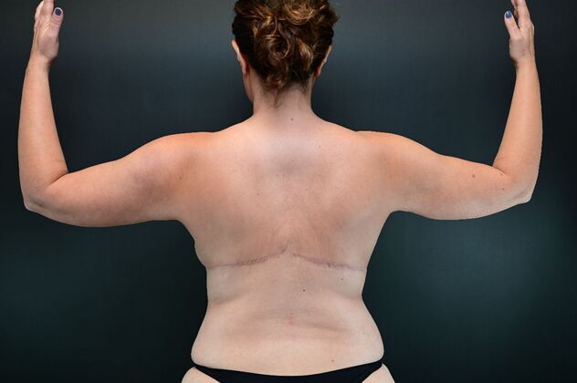 No-incision Arm Lift (lipo and bodytite) Case 1 - Before