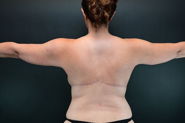 No-incision Arm Lift (lipo and bodytite): Case 1 - Before