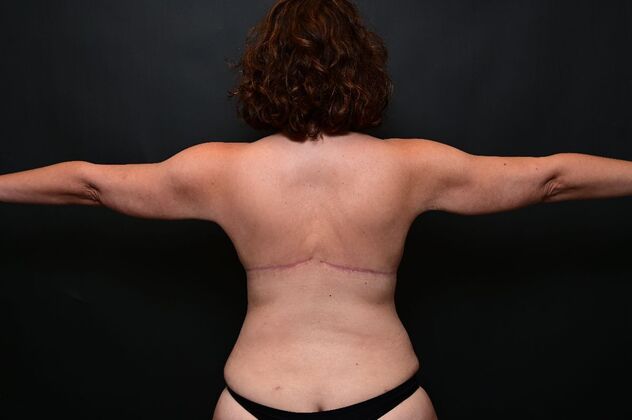 No-incision Arm Lift (lipo and bodytite): Case 1 - After