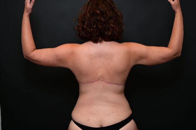 No-incision Arm Lift (lipo and bodytite) Case 1 - After
