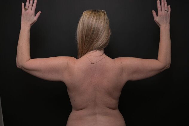No-incision Arm Lift (lipo and bodytite) Case 2 - Before