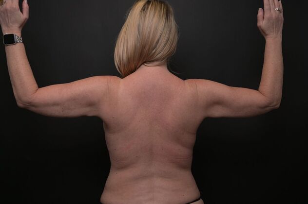 No-incision Arm Lift (lipo and bodytite) Case 2 - After