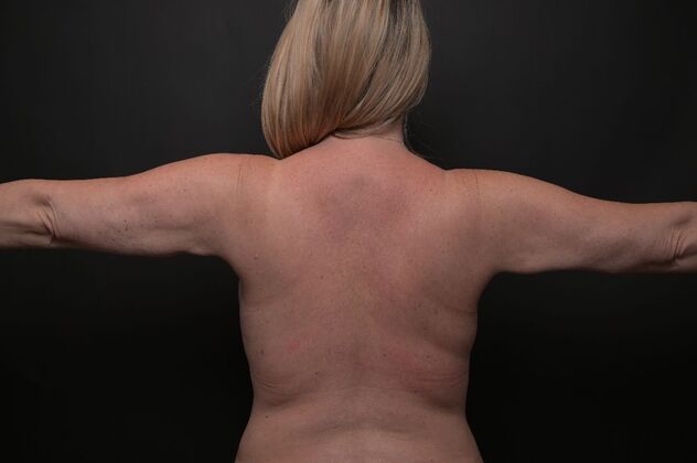 No-incision Arm Lift (lipo and bodytite): Case 2 - After