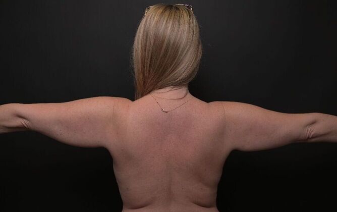 No-incision Arm Lift (lipo and bodytite): Case 2 - Before