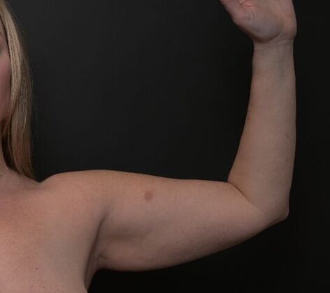 No-incision Arm Lift (lipo and bodytite): Case 2 - Before
