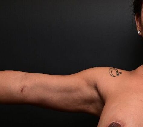No-incision Arm Lift (lipo and bodytite): Case 3 - After
