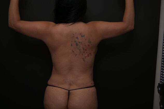 No-incision Arm Lift (lipo and bodytite) Case 4 - Before