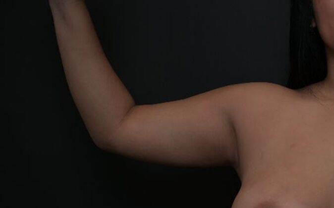 No-incision Arm Lift (lipo and bodytite): Case 4 - Before