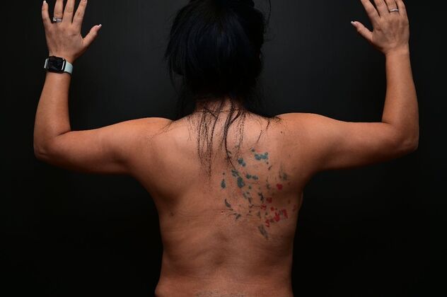 No-incision Arm Lift (lipo and bodytite) Case 4 - After