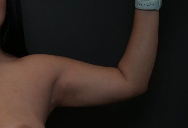 No-incision Arm Lift (lipo and bodytite): Case 4 - Before
