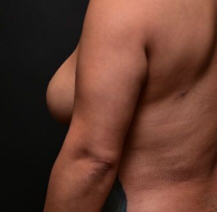 No-incision Arm Lift (lipo and bodytite): Case 4 - After