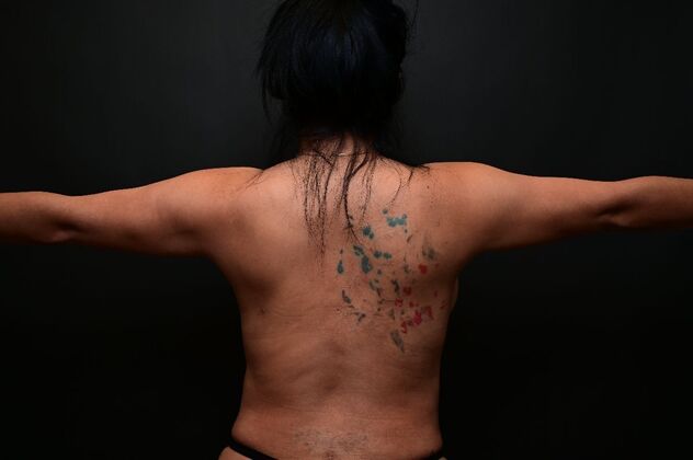 No-incision Arm Lift (lipo and bodytite): Case 4 - After