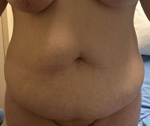 Tummy Tuck (Abdominoplasty): Case 609 - Before