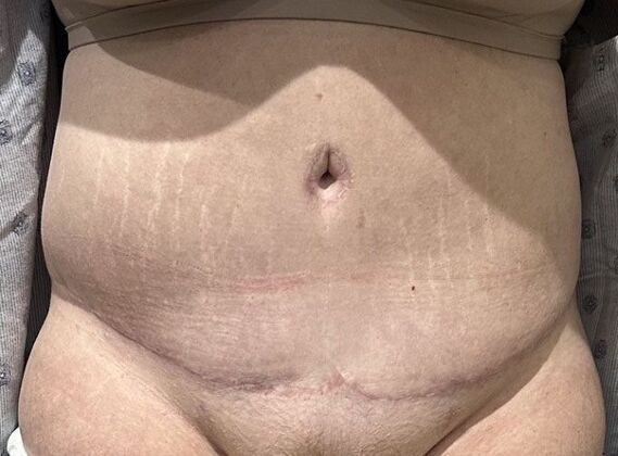 Tummy Tuck (Abdominoplasty): Case 609 - After