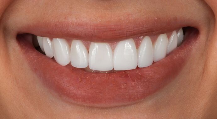 Veneers: Jess - After