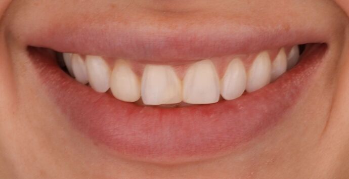 Veneers: Jess - Before