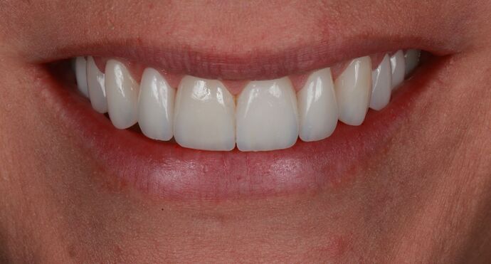 Veneers: Brooke - After