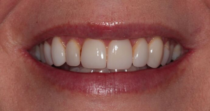 Veneers: Brooke - Before