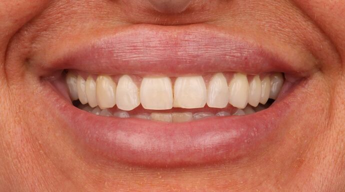 Veneers: Katie - Before
