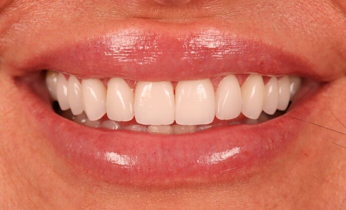 Veneers: Katie - After
