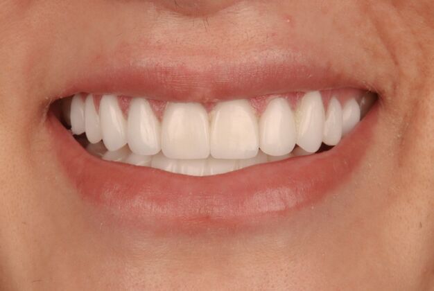 Veneers: Leona - After