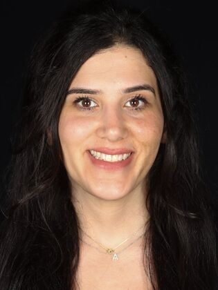 Veneers Leona - Before