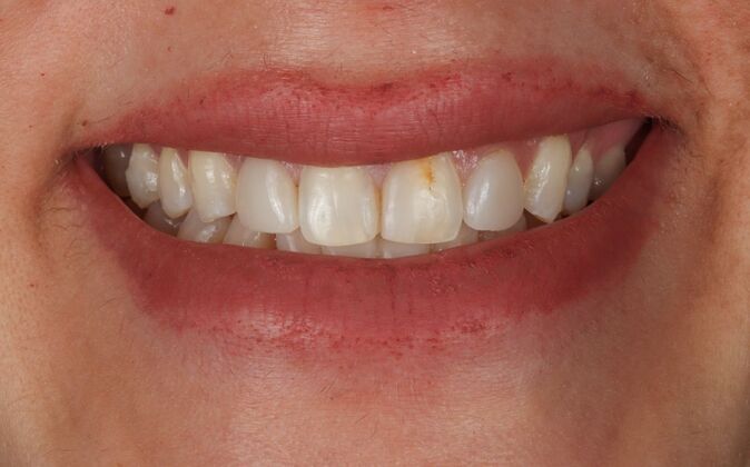 Veneers: Leona - Before