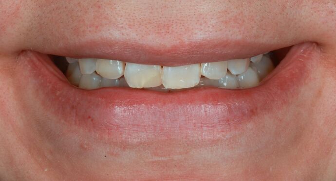 Veneers: Savannah - Before
