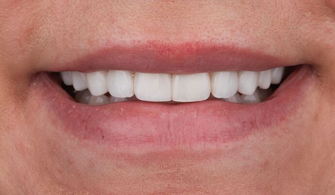 Veneers: Savannah - After