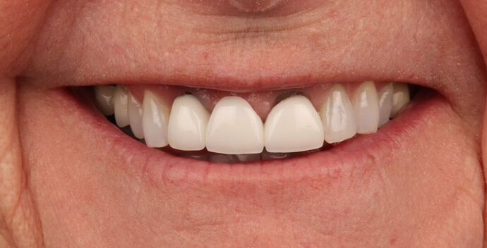 Veneers: Tricia - Before
