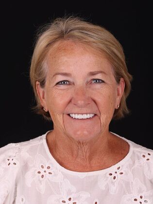 Veneers Tricia - After