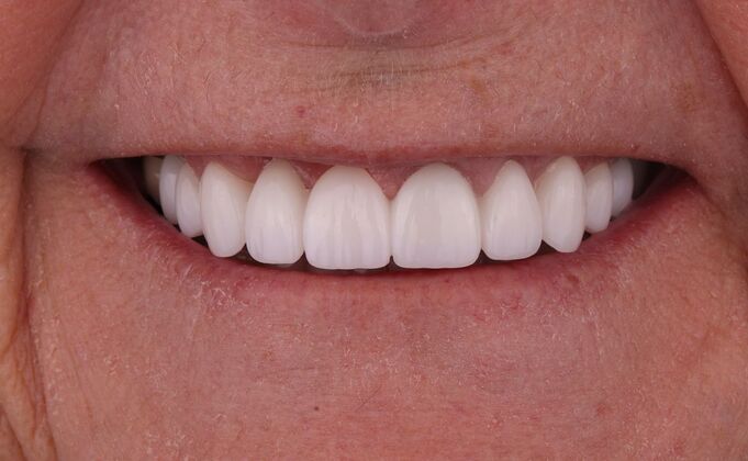 Veneers: Tricia - After