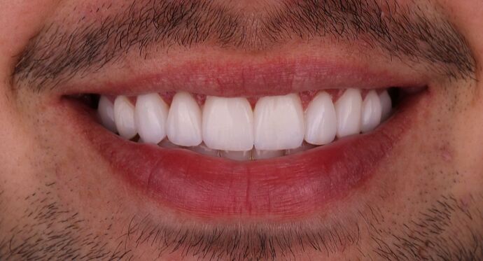 No-Prep Veneers: Alex - After