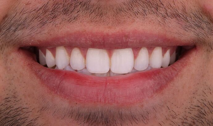 No-Prep Veneers: Alex - Before