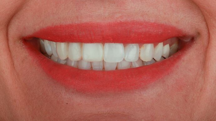 No-Prep Veneers: Diana - Before