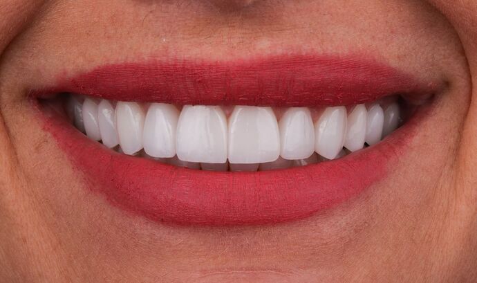 No-Prep Veneers: Diana - After