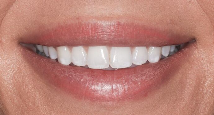 No-Prep Veneers: Kayla - Before