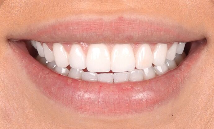 No-Prep Veneers: Kayla - After