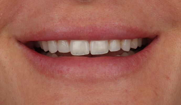 No-Prep Veneers: Kim - Before