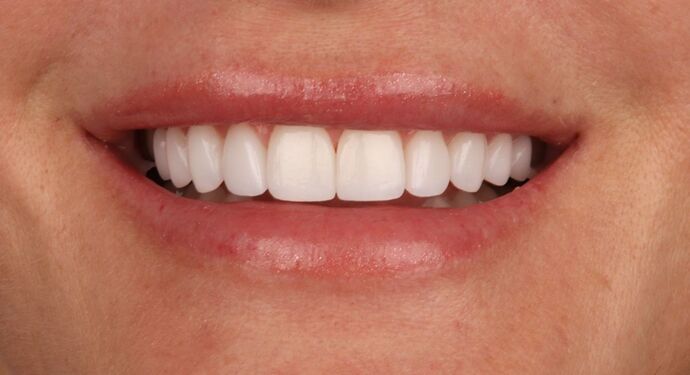 No-Prep Veneers: Kim - After