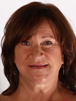 Dental Implants Sherry - Before